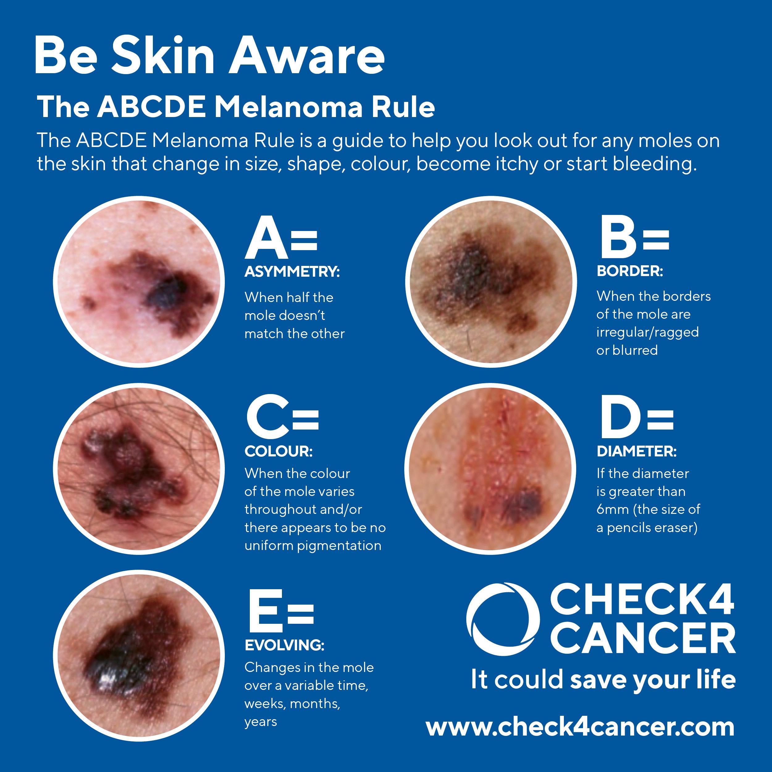 Don't Get Burned: Be Aware Of Melanoma And Skin Cancer